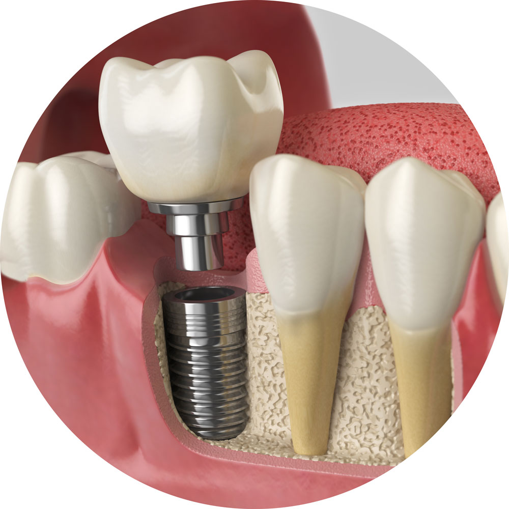 Linwood Dental Care: Implant Model